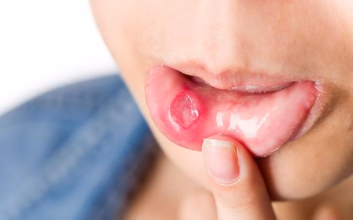 Lở miệng: Đây là một trong những tác dụng phụ phổ biến của hóa trị liệu cũng như xạ trị. Đôi khi nó có thể nghiêm trọng nếu lở loét miệng có thể cản trở bệnh nhân ăn uống. Khi không nhận được đủ chất dinh dưỡng, cơ thể sẽ suy kiệt và dẫn đến một loạt các vấn đề nghiêm trọng khác.