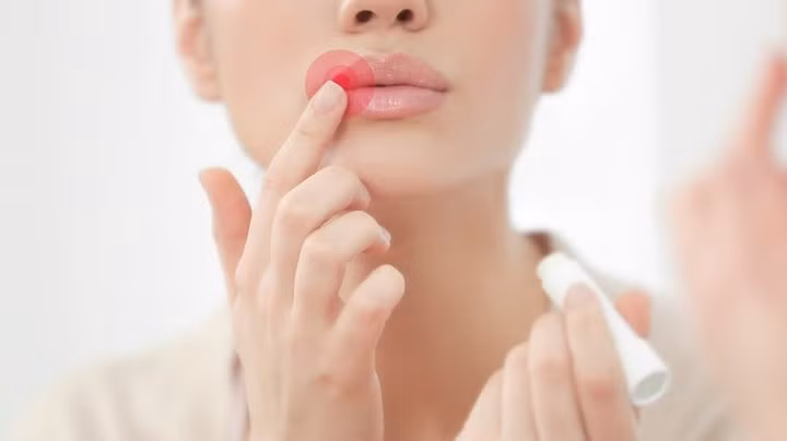 Nhiều tác dụng phụ: May mắn là thay hầu hết các tác dụng phụ có thể có của tiêm môi đều nhẹ và tạm thời. Các rủi ro phổ biến khác có thể là bầm tím, sưng... và thường chỉ kéo dài trong một vài ngày.