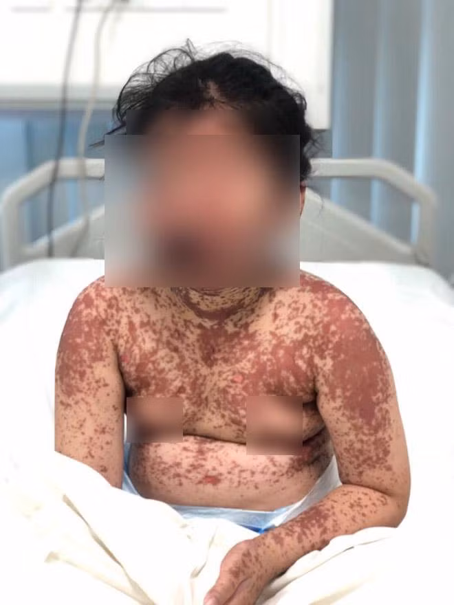 Bệnh nhi được nhập viện trong tình trạng sốt cao, nổi ban da toàn thân, kết mạc mắt bị viêm đỏ, lở loét niêm mạc môi miệng gây đau họng, khó nuốt...
