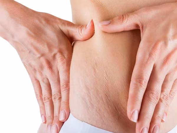 Rạn da. Vấn đề này thường xuyên gặp trong thai kỳ. Nó thường xuất hiện trên bụng, hông và đùi. Mặc dù không có điều trị hoàn chỉnh nào cho hiện tượng này nhưng bạn có thể làm giảm bớt nó bằng cách dùng các loại kem có chứa vitamin A.