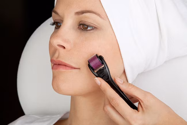 Phương pháp lăn kim. Giúp tăng cường sản sinh collagen mới dưới da để làm đầy và mờ các sẹo mụn thâm hay lõm. Tuy nhiên với sẹo lồi không nên dùng phương pháp này vì nó có thể làm tổn thương các mô da hay thậm chí là khiến sẹo lồi dày hơn.