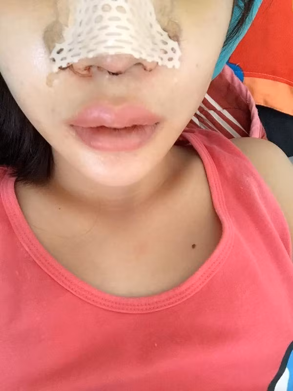 Thời gian gần đây, chuyện phụ nữ làm đẹp, phẫu thuật thẩm mỹ để thay đổi cuộc sống, tìm kiếm sự tự tin không còn là chuyện lạ. Nhưng những người chấp nhận phẫu thuật thẩm mỹ toàn thân trong cùng một thời điểm, quyết tâm vượt qua đau đớn, lột xác hoàn toàn như cô gái trẻ tên Kim lại không phải trường hợp phổ biến.