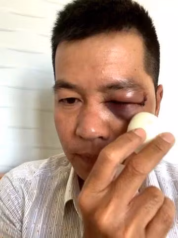 Công an thông tin về vụ đánh người dã man trong tiệm thuốc Tây: Chiều 26/8, nguồn tin của phóng viên cho biết Cơ quan Cảnh sát điều tra Công an huyện Phù Cát vừa gửi thông báo kết luận giám định pháp y về thương tích đối với ông Đinh Quốc Tùng (44 tuổi; ngụ thôn An Quang Đông, xã Cát Khánh). Trước đó, ngày 23/6, trong lúc ông Tùng đang làm việc tại quầy thuốc Tây ở xã Cát Khánh thì bất ngờ bị 2 anh em ruột Nguyễn Tùng Sơn (37 tuổi) và Nguyễn Đức Lợi (30 tuổi, cùng ngụ địa phương) xông vào chửi bới rồi hành hung vào đầu, mặt, mắt và ngực.