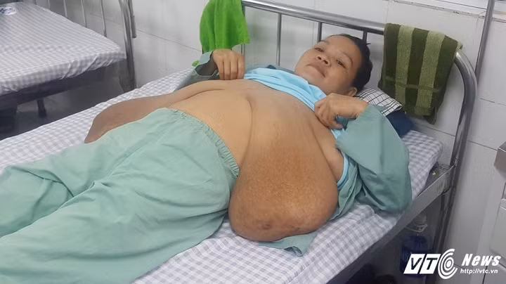 Tìm ra cách cứu cô gái có ngực chảy xệ xuống đùi Tim ra cach cuu co gai co nguc chay xe xuong dui