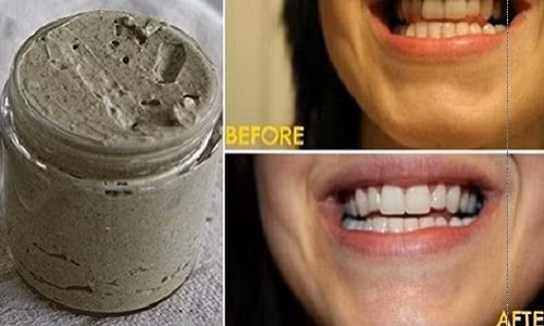 Học cách tự chế kem đánh răng chữa sâu răng hiệu quả Hoc cach tu che kem danh rang chua sau rang hieu qua
