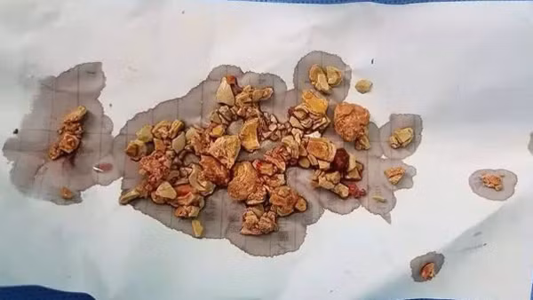 Phần sỏi được lấy ra Phần sỏi được lấy ra