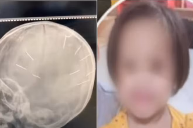 Vu be gai 3 tuoi tu vong do bi dong 9 dinh vao dau: “Mong o the gioi ben kia, con se khong con bi noi dau day vo“