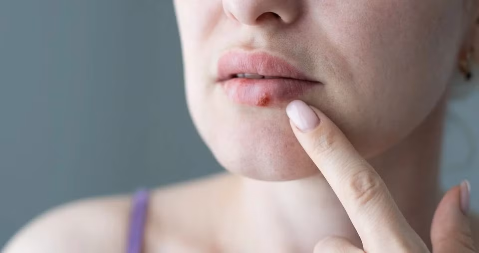 Mụn rộp: Mụn rộp hoặc vết loét lạnh được tạo ra bởi virus herpes loại I, theo WebMD. Mụn rộp ở miệng là loại phổ biến nhất, lây lan qua nước bọt hoặc dịch cơ thể. Virus này hoạt động và phát triển các triệu chứng như lở loét khi một người bị căng thẳng, trầm cảm, ốm yếu hoặc mệt mỏi. Ảnh: Health.