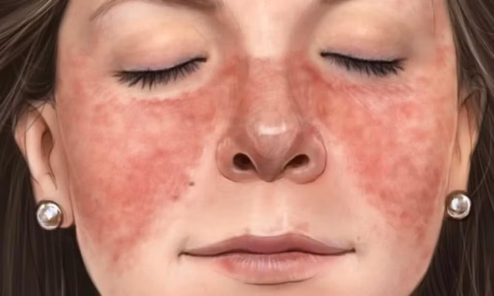 Má đỏ: Theo WebMD, bạn có thể đỏ mặt do bối rối, sốt, dùng thuốc và một số lý do khác nhưng nếu mặt bạn thường xuyên đỏ, đây là dấu hiệu của tình trạng sức khỏe khác. Các nguyên nhân có thể bao gồm tình trạng da phổ biến như bệnh hồng ban và viêm da tiết bã, viêm da dị ứng hay bệnh lupus, ảnh hưởng đến các cơ quan khác trong cơ thể bạn. Lupus có thể biểu hiện bằng phát ban hình con bướm ở mũi và má. Ảnh: Healthjade.