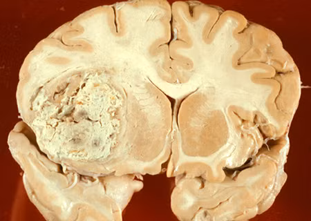 Ung thư Glioma: Đây là bệnh ung thư tế bào glio trong não. Bệnh không thường gặp nhưng cũng có tới 8% bệnh nhân bị do di truyền từ cha mẹ, ông bà... Ảnh: Ungbuouhungviet.