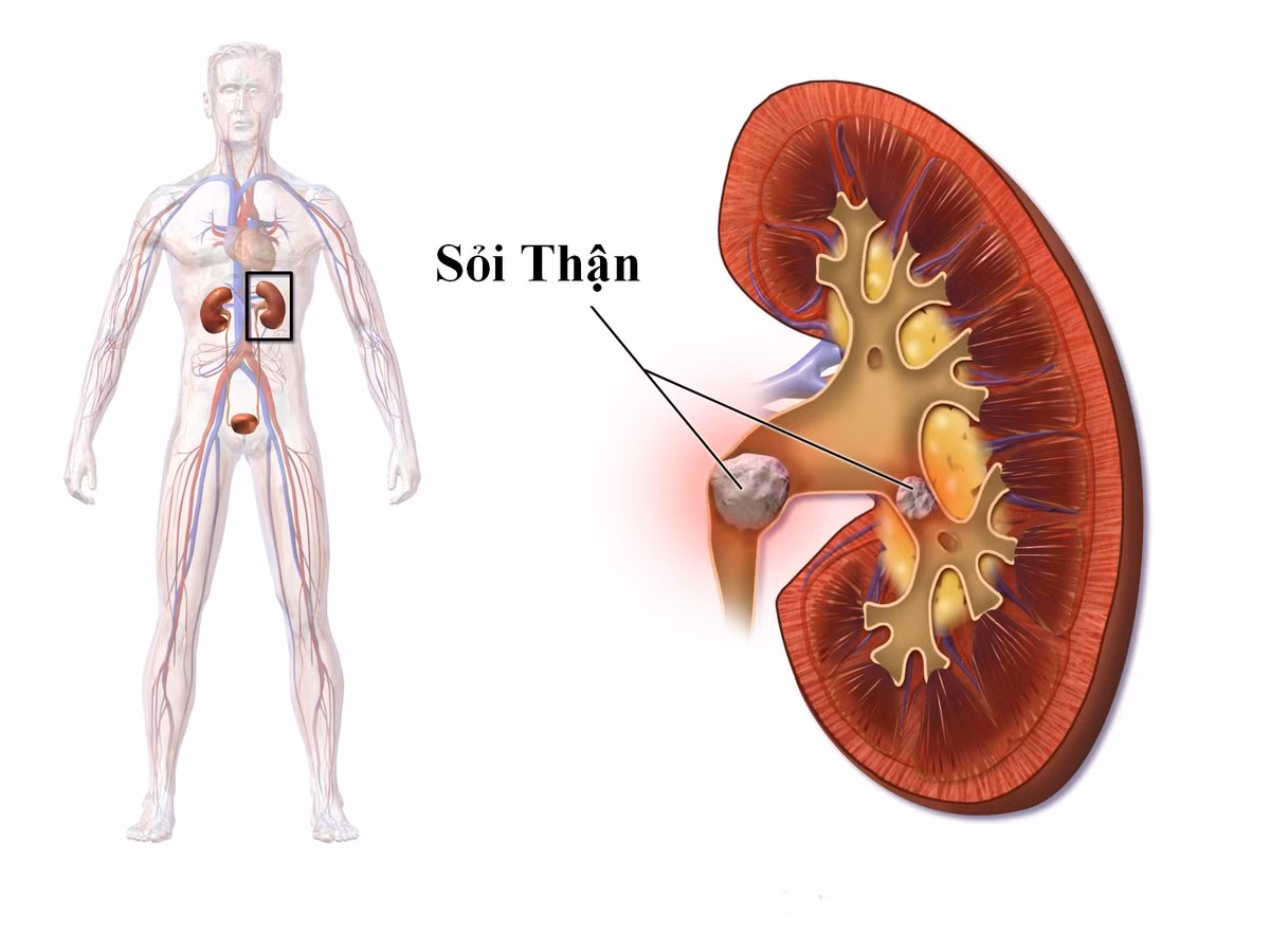 Trị sỏi đường tiết niệu sỏi thận: Lấy thân hướng dương sắc nước uống. Uống đều đặn trong khoảng 1 tuần có thể uống thay nước hằng ngày. Ảnh: Sức khỏe xanh. 