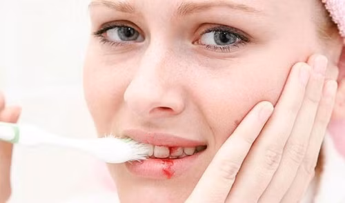 Người bị chảy máu chân răng, tụt lợi cũng lấy rễ mù u sắc lên cùng rễ cây kỷ ngậm. Ảnh: Nha khoa paris. 