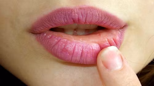 Ung thư môi: Môi cũng là vùng cơ thể thường xuyên tiếp xúc với ánh mặt trời chính vì thế nó hoàn toàn có thể bị ung thư do nhưng tia xấu từ mặt trời tác động nên. Ảnh: Baonghean.