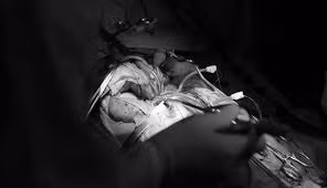 Ghép phổi: Thủ thuật ghép cơ thể người này cho người lớn chuẩn bị được các bác sĩ Việt thực hiện vào tháng 9 tới đây. Bệnh nhân được ghép phổi đầu tiên này là một bệnh nhân nam bị bệnh lý về phổi. luôn phải duy trì sự sống bằng máy thở. Phổi ghép được lấy từ một người chết não hiến tạng.