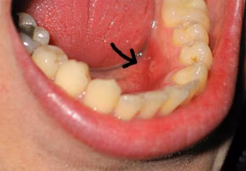 8. Vết loét miệng lâu lành. Bạn có thể đang bị ung thư miệng. Với bệnh lý ác tính như ung thư vòm họng, ung thư lưỡi, loét là triệu chứng ban đầu thể hiện bệnh đang ở giai đoạn sớm. Vì vậy, nếu đi khám sớm để có thể phát hiện từ giai đoạn này thì việc điều trị sẽ thuận lợi hơn rất nhiều, đồng thời tỷ lệ điều trị bảo tồn gần như là 100%.