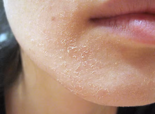 Uống nhiều nước chữa trị da khô? Uống nước không phải là bí quyết chủ yếu để cải thiện làn da khô, dù nước đem lại rất nhiều lợi ích cho toàn bộ cơ thể. Khắc phục làn da khô ngay tức thì gồm hai bước khá đơn giản: tránh mọi thứ có thể làm da khô hơn, từ tắm lâu tới phơi nắng và những chất gây kích ứng như bột giặt, rượu và thuốc lá.