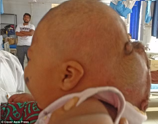 Cậu bé được xuất viện mới đây sau gần một tháng nằm viện và đang được điều trị và theo dõi tại nhà. Cậu bé sẽ được đưa đến bệnh viện để được kiểm tra định kỳ 3 tháng một lần. 