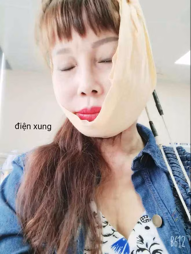 Chủ nhân bài đăng cho hay, vết thương vẫn còn khá đau và vợ chồng hiện tượng mạng họ Lê quyết định ở lại Hà Nội tới ngày cắt chỉ rồi mới di chuyển về Cao Bằng.