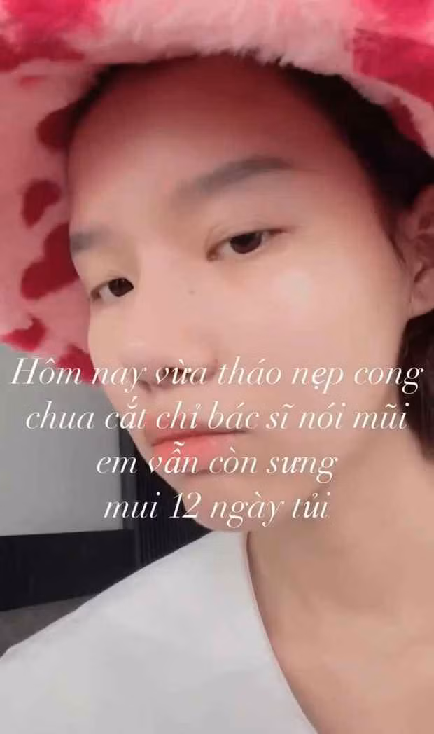 Ngoài ra, cô nàng tiết lộ dáng mũi đều muốn bác sĩ lựa chọn để phù hợp nhất với gương mặt và thời gian phẫu thuật mất 4 tiếng đồng hồ.