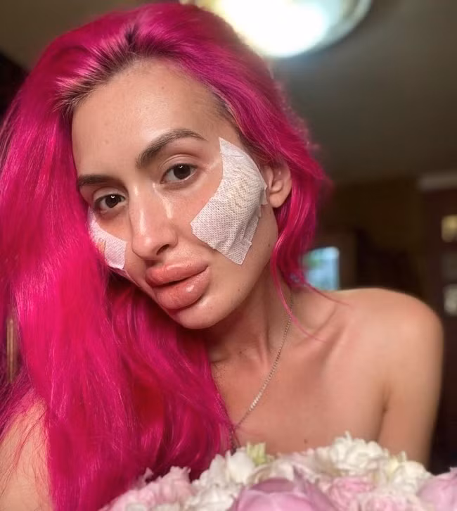 Thậm chí, Anastasia từng chia sẻ: "Tôi yêu chúng, tôi luôn muốn khuôn mặt phải như ý mình và tôi hài lòng với điều đó. Tôi cũng tự chích nhiều nơi trên mặt. Nhiều người bảo tôi là thứ dở hơi xấu xí và nên tự sát đi. Tôi chỉ cười và bỏ qua thôi".