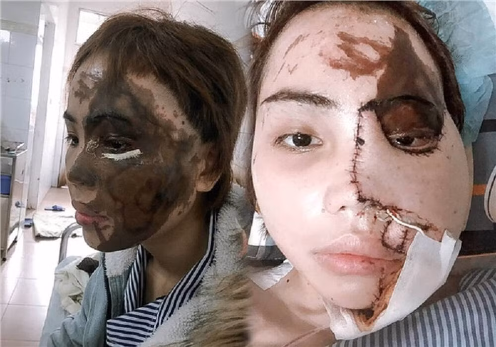 Cách đây hơn 2 năm, hình ảnh cô gái Đà Nẵng bị chồng sắp cưới tạt axit khiến khuôn mặt bị biến dạng đã nhận về sự quan tâm cực lớn của dân mạng. Thời điểm ấy, nữ chính phải đối mặt nhiều nỗi đau về thể xác lẫn tinh thần.