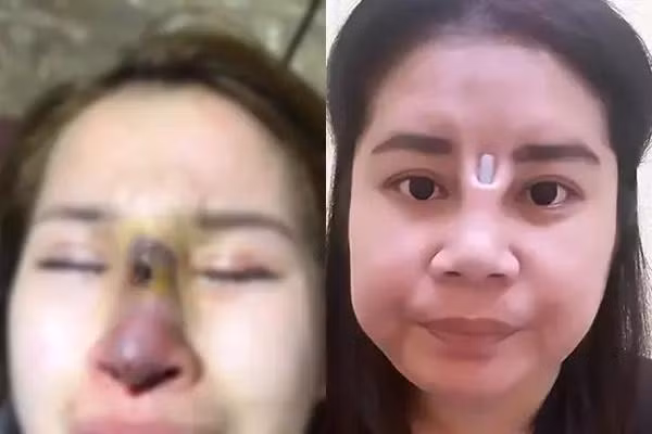 Nhiều người còn bị hoại tử mũi, hay sụn mũn lòi ra khỏi thịt.