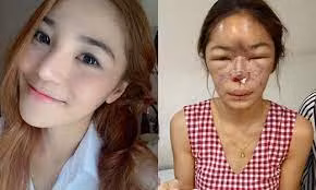 Cách đây không lâu, trên các fanpage nhiều cô nàng đã chia sẻ về hình ảnh nâng mũi bị hỏng của mình khiến ai nhìn thấy cũng phát sợ.