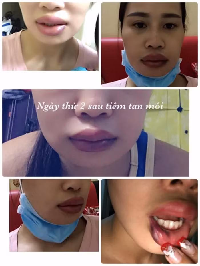 Theo kinh nghiệm của một số chị em trong ngành phun xăm cho hay, tình trạng này rất có thể là phun môi bị cháy tê khiến cho phần da bị tổn thương nghiêm trọng.
