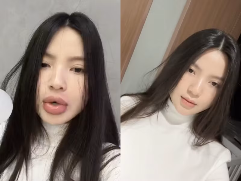 Quang Hải sau đó đã khuyên bà xã nên đi tiêm tan môi để lấy lại hình dáng môi như ban đầu.