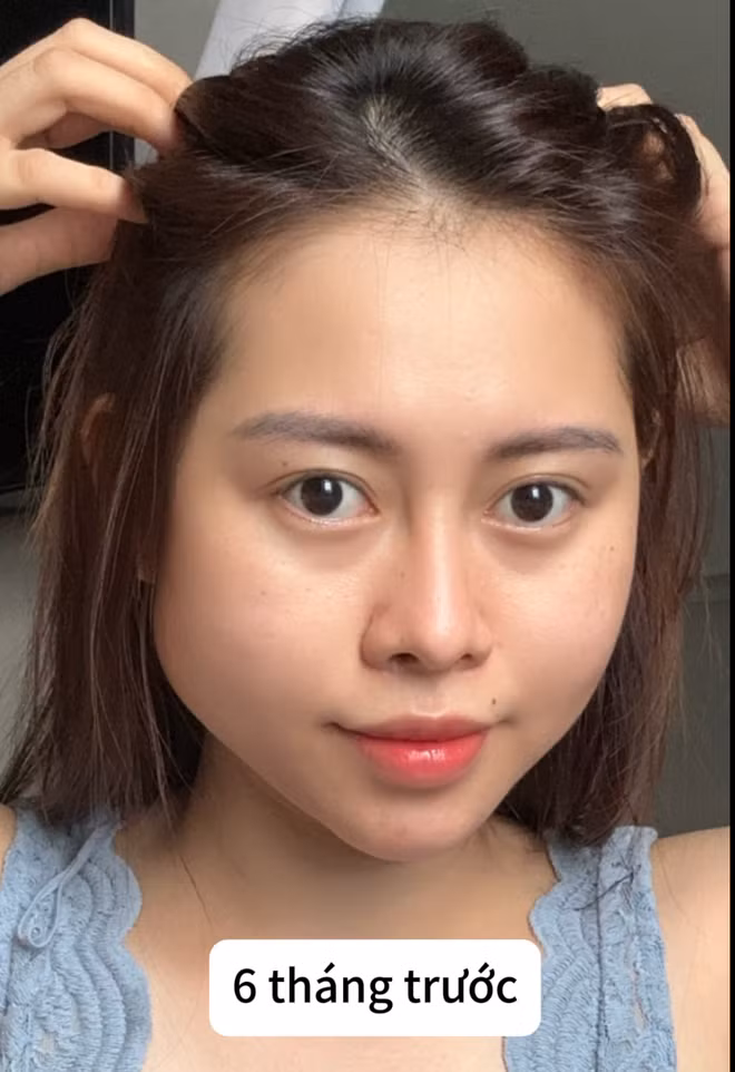 Năm 2017, khi này Việt Phương Thoa có gương mặt hóp và cằm chẻ, cô mong muốn đi tiêm filler để gương mặt baby và đầy đặn hơn, có nhiều cơ hội phát triển trong nghề nghiệp.