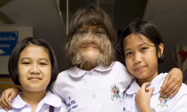 việc Supatra Sasuphan mắc phải căn bệnh "người sói" cũng chẳng thể chữa trị được, phải sống cả đời với thân hình nhiều lông như vậy.