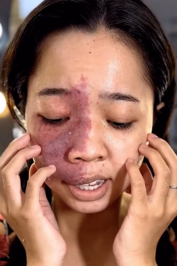 Bất cứ ai có khuyết điểm như thế này trên mặt sẽ cảm thấy không tự tin về bản thân, lúc nào cũng chỉ muốn giấu mặt của mình đi, không tự tin khi giao tiếp, nói chuyện với người khác. Có lẽ vì vậy mà cô gái đã khóc, thể hiện tâm trạng, những cảm xúc mà mình từng phải trải qua.