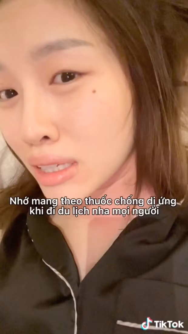 Sau khi clip lộ mặt mộc của Thanh Thanh Huyền lên sóng, dân mạng vào hỏi thăm và tìm ra nguyên nhân. Hóa ra cô nàng bị dị ứng do ăn hải sản lạ trong chuyến du lịch.