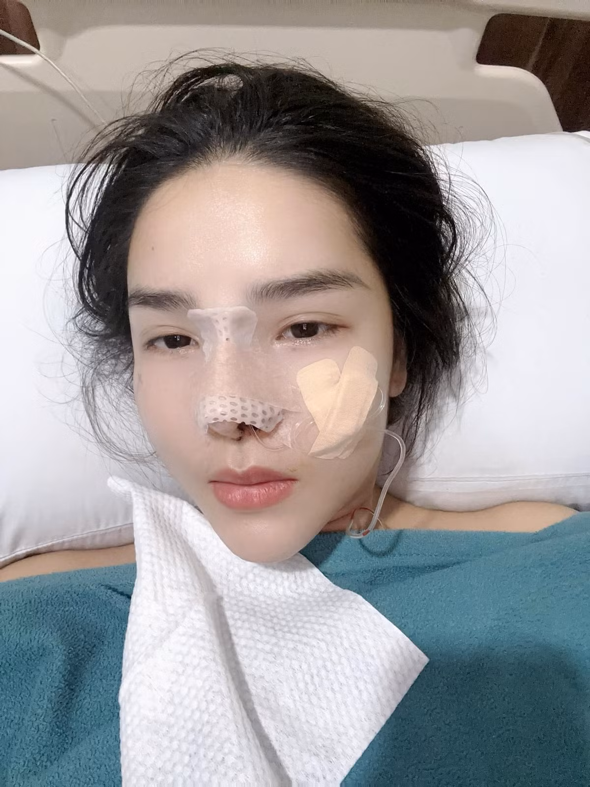 Nàng siêu mẫu cũng chia sẻ thêm về việc Mạc Hồng Quân không ủng hộ vợ phẫu thuật thẩm mỹ từ nhiều năm nay, song ở lần này vì mũi của cô gặp vấn đề nên ông xã bắt buộc phải đồng ý và vẫn chăm sóc cô trong quá trình sửa mũi.