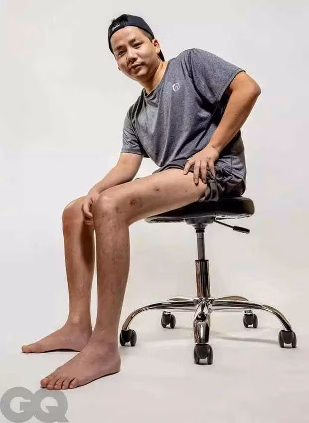Nội dung của bài báo là chia sẻ của những người đàn ông đã và đang thực hiện phẫu thuật kéo chân.