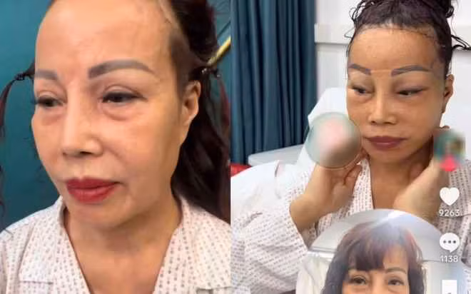 Có thể thấy, cô Thu Sao cũng không tránh khỏi dấu hiệu tuổi tác, nếp nhăn và di chứng méo miệng từ những lần phẫu thuật thẩm mỹ trước đó.