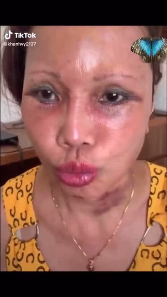 Trong lần chỉnh sửa này, cô dâu Thu Sao quyết định đại phẫu kéo căng da mặt, phải nói đây là một quyết định khá táo bạo ở độ tuổi của chị bởi không chỉ đau đớn mà nó còn khá nguy hiểm vì chị đã lớn tuổi.