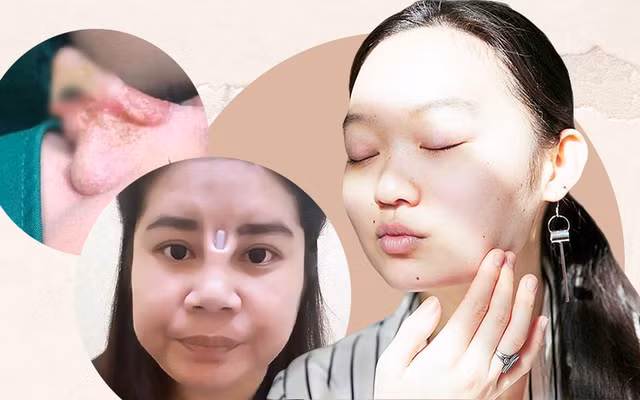 Không ít trường hợp, các cô gái bị hoại tử vùng mũi, trán sau khi tiêm filler làm đẹp.