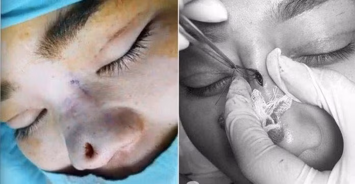 Cận cảnh chiếc mũi thủng lỗ khiến ai nhìn cũng rùng mình. Đi kèm hình ảnh, cô gái gửi lời cảnh tỉnh đến mọi người: "Nói thật với mấy chị em, đừng ham (nâng mũi) cao vì không bền đâu ạ...".