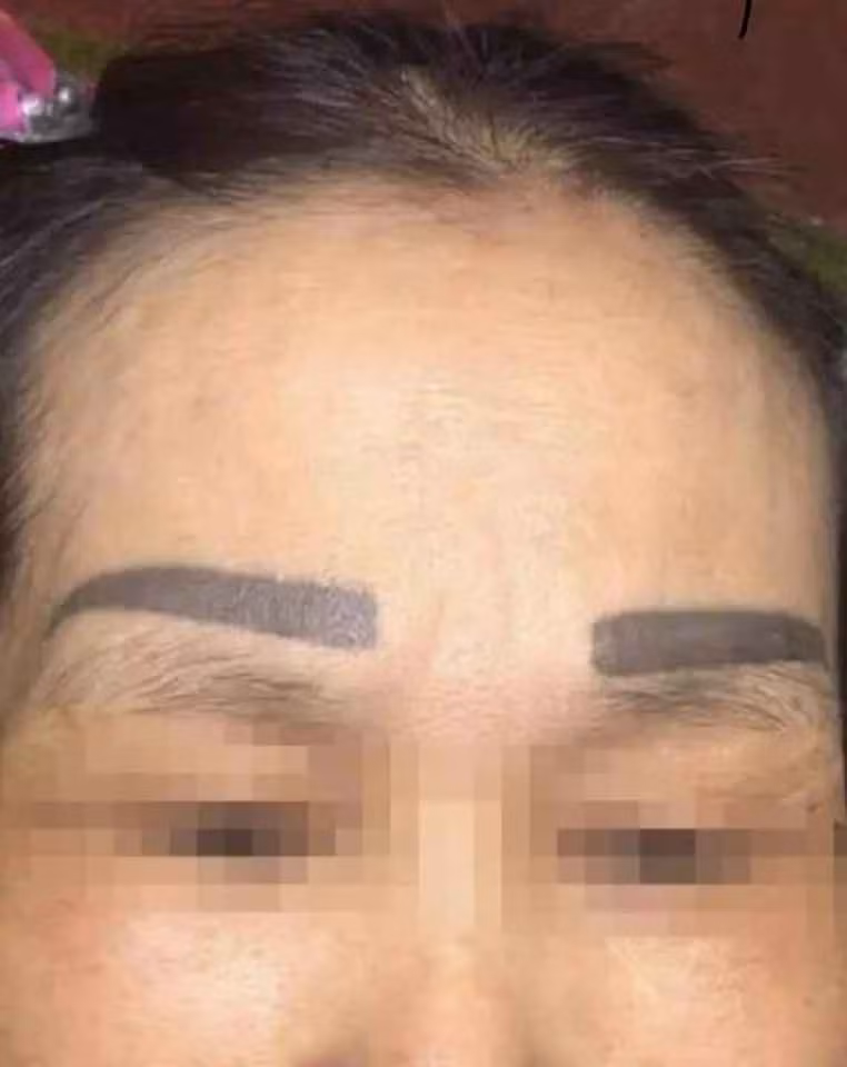 "Đây là một ca cấy lông mày có thể nói là khiến chị em trầm cẻm luôn sau vài ngày. Với trường hợp này, có lẽ chỉ còn cách cắt bỏ hết phần lông mày hỏng rồi phun lại. Bên cạnh đó cũng khuyên chị em nên thật sự cẩn trọng khi lựa chọn làm đẹp tại một cơ sở nào đó, đừng quá tin vào quảng cáo kẻo lại tiền mất tật mang", trích bài đăng trên diễn đàn.