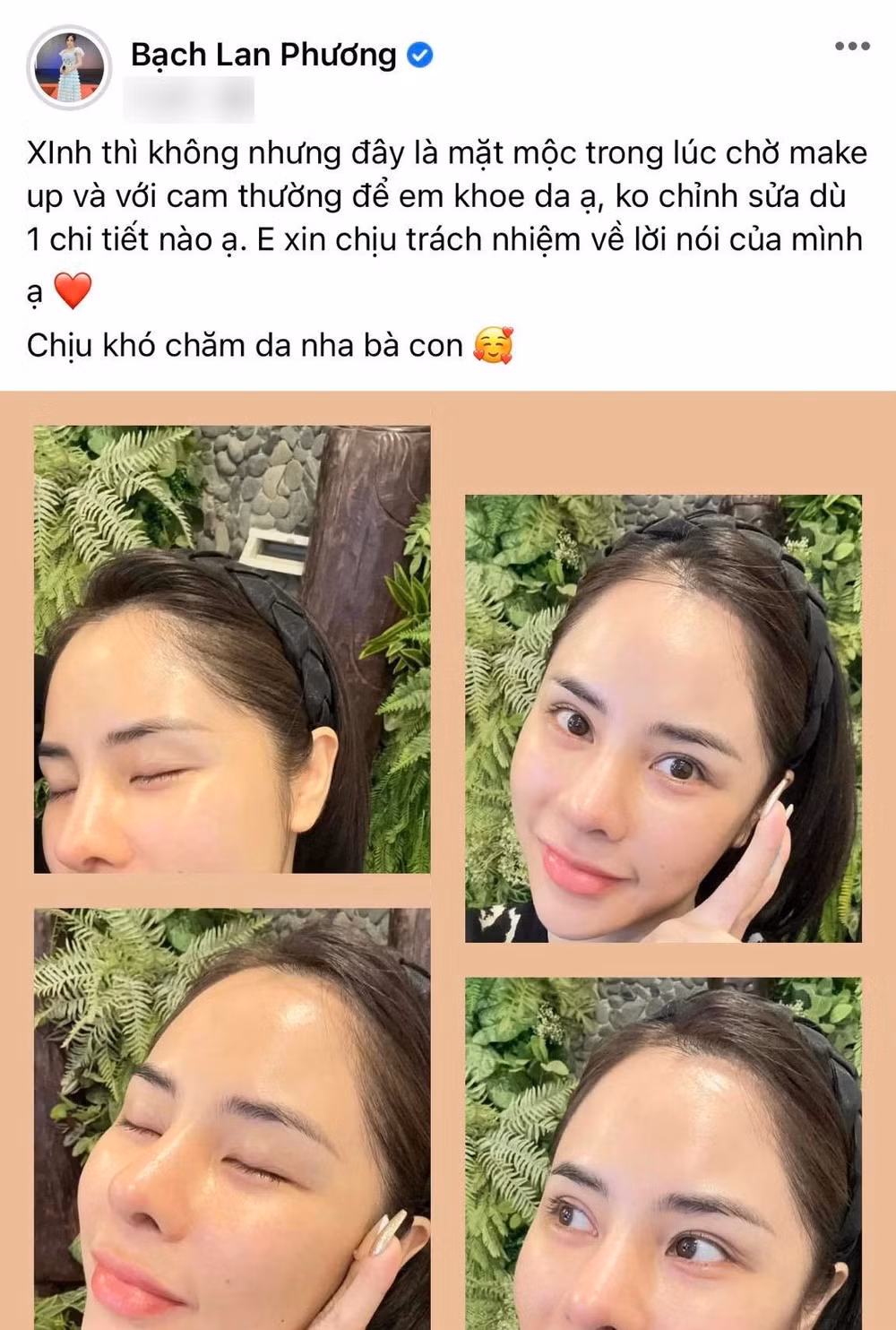 Theo đó, bạn gái Huỳnh Anh cho biết đã thực hiện nhấn mí vì không muốn sử dụng kích mí mà có một đôi mắt to, đẹp hơn.