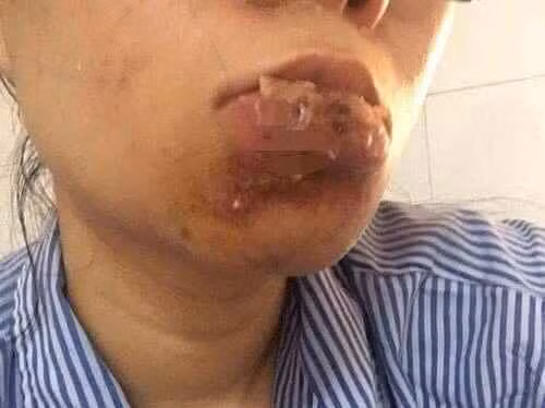"Tôi không biết chuyện gì đã xảy ra. Ban đầu, tôi nghĩ có lẽ là do tôi đã không tiêm môi trong hơn 1 năm. Nhưng khi lên xe về nhà, tôi nhận ra điều này không bình thường và quay trở lại phòng khám, báo với bác sĩ", cô gái chia sẻ. (Ảnh minh hoạ)