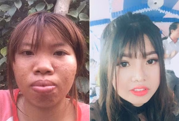 Cách đây 4 năm, Phượng "thị nở" gây xôn xao mạng xã hội khi công khai hình ảnh của bản thân trước và sau phẫu thuật thẩm mỹ.
