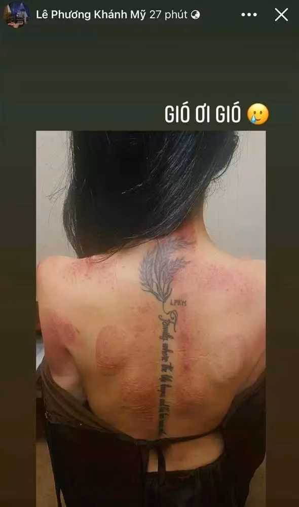 Theo đó, gái xinh đình đám một thời chụp phần cánh tay và lưng xuất hiện dày đặc vết sứt sát đỏ, bầm tím.