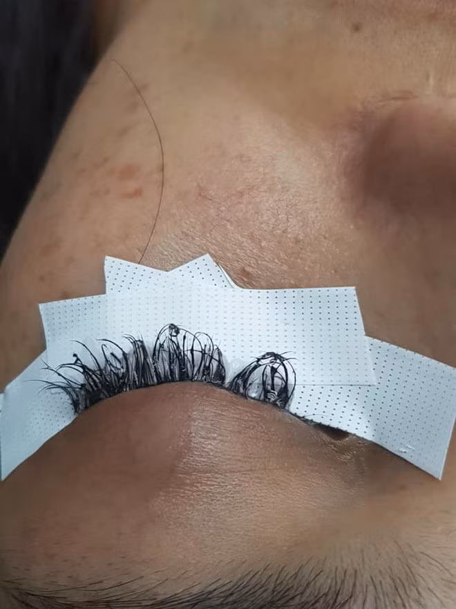 Nối mi thì phải dùng đến keo nên có trường hợp bị dị ứng dẫn đến viêm da vùng mi hay viêm kết mạc. Thậm chí, nguy hiểm hơn chính là hỏng giác mạc do biến chứng sau nối mi.