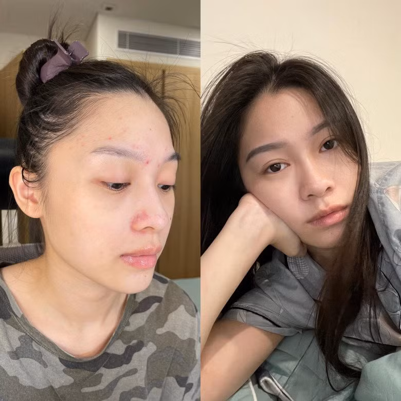 Là MC VTV, giữ dáng là điều quan trọng, song với các mỹ nhân này, chăm sóc da là việc quan trọng hơn. Hạnh Quyên cũng từng có khoảng thời gian stress vì mụn do make-up quá nhiều. Cô từng phải cầu cứu đồng nghiệp vì tình trạng da mặt tệ, nhiều mụn ẩn, đầu đen và cô không tự xử lý được.