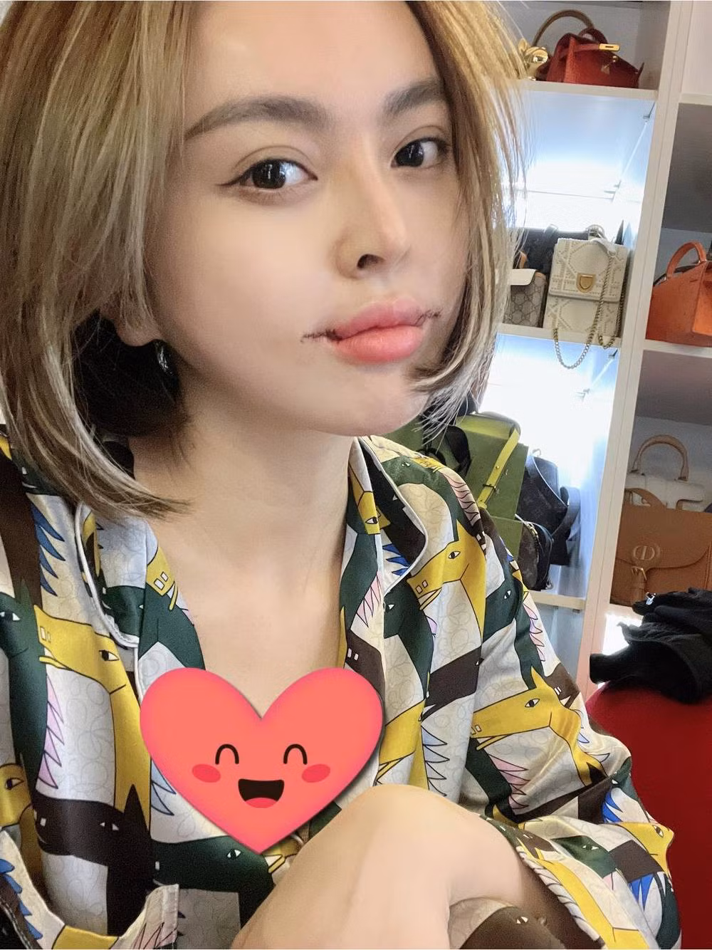 Vì vừa phẫu thuật xong và vết thương vẫn còn chưa lành, dấu vết dao kéo vẫn còn rất rõ trên miệng Trang Nemo.
