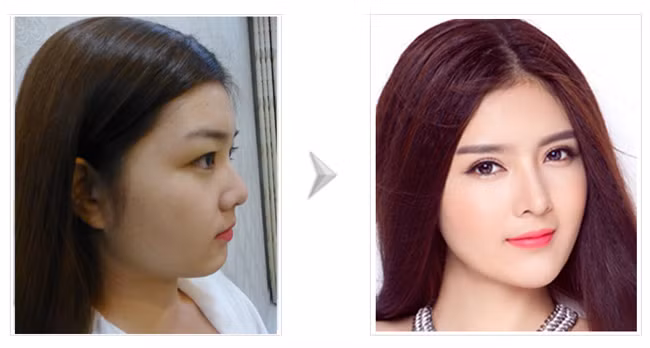 Trước thẩm mỹ, mũi của Lilly Luta đẹp nhưng cô vẫn muốn tăng thêm độ hoàn hảo bằng việc dùng tới "dao kéo".