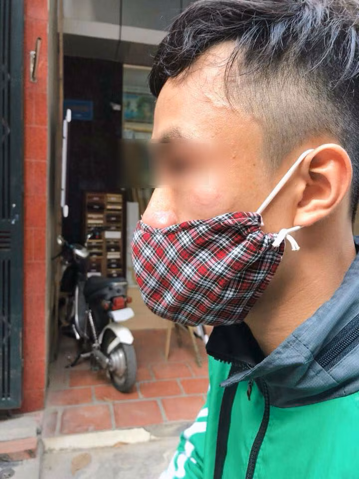 Tài xế Grab Bike bị một người đàn ông vô cớ đấm vào mặt. Ảnh: Joog Nguyen.