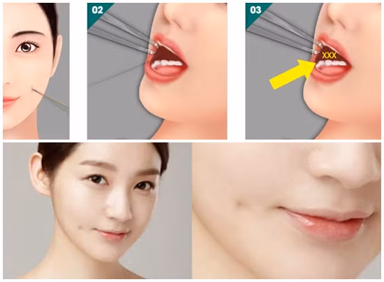 Tiến hành tạo má lúm. Dựa trên kết quả thăm khám và đo vẽ thẩm mỹ trước đó, bác sĩ sẽ tiến hành trích một vết nhỏ ngay tại vị trí được xác định làm má lúm đồng tiền bên trong niêm mạc miệng má.